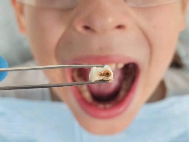 Best Emergency Wisdom Teeth Removal in Eagle Lake, TX